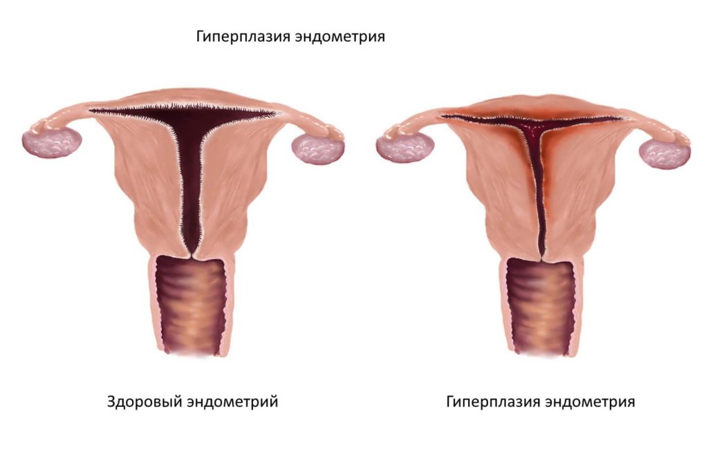 Гиперплазия эндометрия